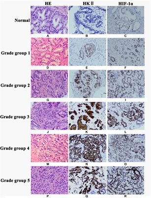 Expression and Clinical Significance of HKII and HIF-1α in Grade Groups of Prostate Cancer